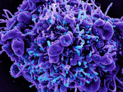 Imagen obtenida mediante microscopio electrónico de barrido y coloreada posteriormente de una célula apoptótica (en morado) infectada con partículas de SARS-CoV-2 (azules), aislada de una muestra de pacientes. Imagen: National Institute of Allergies and Infectious Diseases, NIAID.