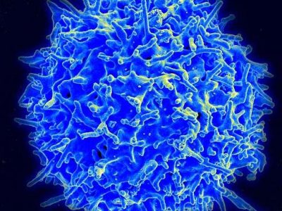 leucemia linfoblástica aguda