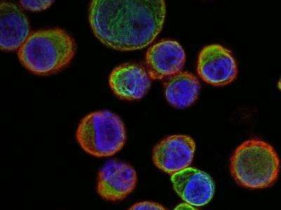 Las células tumorales circulantes son una de las fuentes del ADN tumoral en el torrente sanguíneo. Imagen: Universidad de Granada.