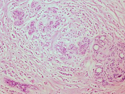 Carcinoma de mama. Imagen: By Ed Uthman from Houston, TX, USA CC-BY-2.0