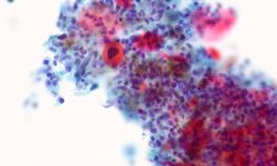 Carcinoma de pulmón de células escamosas. Imagen: Ed Uthman, CC BY. 2.0.