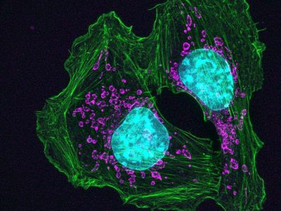 Células de cáncer de piel de ratón. Catherine and James Galbraith, Oregon Health and Science University, Knight Cancer Institute (Image and Video Gallery, National Institute of Health, EEUU).