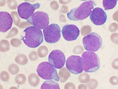 Leucemia aguda linfoblástica de células B. By VashiDonsk at en.wikipedia [GFDL (http://www.gnu.org/copyleft/fdl.html) or CC-BY-SA-3.0 (http://creativecommons.org/licenses/by-sa/3.0/)], from Wikimedia Commons