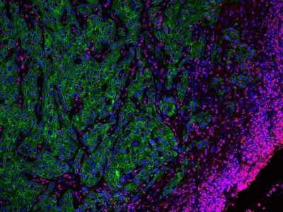 Un frente de células tumorales muy agresivas (en verde). Imagen de microscopia confocal (Autora: Alexandra Avgustinova, IRB Barcelona).