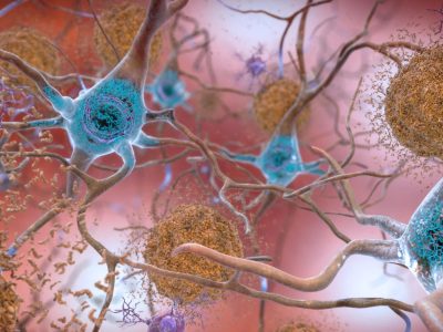 Fisiopatología de la enfermedad de Alzhéimer. National Institute on Aging, NIH CC BY NC 2.0 https://creativecommons.org/licenses/by-nc/2.0/).