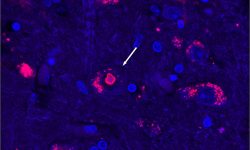 Tejido cerebral de un paciente con SCA4. El ADN celular se muestra teñido en azul y el rojo representa una proteína que aumenta cuando se interrumpe el reciclaje de proteínas. La acumulación en rojo brillante es un grupo de proteínas que sólo se observa en pacientes con SCA4. Imagen: Mandi Gandelman, University of Utath.