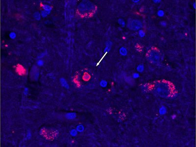 Tejido cerebral de un paciente con SCA4. El ADN celular se muestra teñido en azul y el rojo representa una proteína que aumenta cuando se interrumpe el reciclaje de proteínas. La acumulación en rojo brillante es un grupo de proteínas que sólo se observa en pacientes con SCA4. Imagen: Mandi Gandelman, University of Utath.