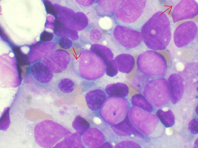 Leucemia Mieloide Aguda. Imagen: CIBERESP.