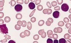 Células B en leucemia linfocítica crónica. By The Armed Forces Institute of Pathology (AFIP) [Public domain], via Wikimedia Commons