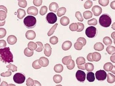 Células B en leucemia linfocítica crónica. By The Armed Forces Institute of Pathology (AFIP) [Public domain], via Wikimedia Commons