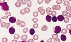 Células B en leucemia linfocítica crónica. By The Armed Forces Institute of Pathology (AFIP).