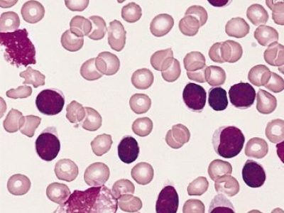 Células B en leucemia linfocítica crónica. By The Armed Forces Institute of Pathology (AFIP).