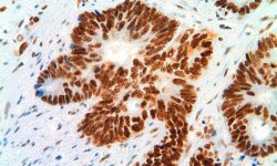 Carcinoma de colon de uno de los portadores de la mutación FAN1 c.141C>A (p.C47*). En la imagen se muestra la expresión de MLH1, una de las proteínas del sistema de reparación de bases desapareadas del ADN. Imagen cortesía de Laura Valle. Instituto Catalán de Oncología-IDIBELL.