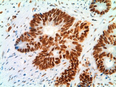 Carcinoma de colon de uno de los portadores de la mutación FAN1 c.141C>A (p.C47*). En la imagen se muestra la expresión de MLH1, una de las proteínas del sistema de reparación de bases desapareadas del ADN. Imagen cortesía de Laura Valle. Instituto Catalán de Oncología-IDIBELL.