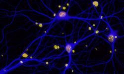 Niveles reducidos de BRCA1 (en rojo) en las neuronas (en azul) de pacientes con Alzhéimer.Imagen: Elsa Suberbielle, Gladstone Institutes.