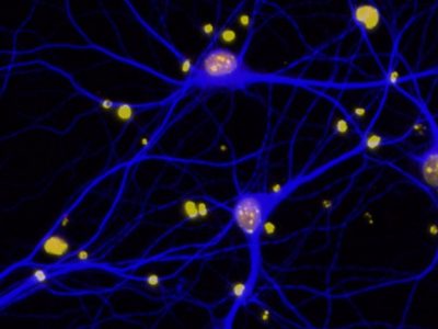 Niveles reducidos de BRCA1 (en rojo) en las neuronas (en azul) de pacientes con Alzhéimer.Imagen: Elsa Suberbielle, Gladstone Institutes.