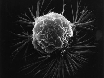 Célula tumoral del cáncer de mama. Imagen: National Cancer Institute.