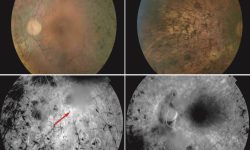 Fenotipo de unos de los pacientes de RP con mutaciones en el gen ZNF408. Arriba fondo de ojo donde se observa palidez de la papila óptica, atenuación de los vasos de la retina y pigmentación en espículas. Abajo Angiografía que muestra las condensaciones vítreas en algunas áreas (flechas rojas). Imagen: A. Avila-Fernandez,, R. Perez-Carro, M. Corton, C. Ayuso.