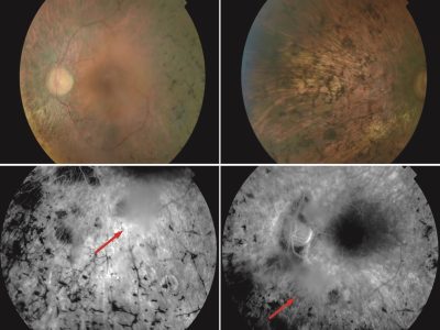 Fenotipo de unos de los pacientes de RP con mutaciones en el gen ZNF408. Arriba fondo de ojo donde se observa palidez de la papila óptica, atenuación de los vasos de la retina y pigmentación en espículas. Abajo Angiografía que muestra las condensaciones vítreas en algunas áreas (flechas rojas). Imagen: A. Avila-Fernandez,, R. Perez-Carro, M. Corton, C. Ayuso.