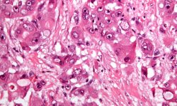 Carcinoma hepatocelular como el utilizado para estudiar el crecimiento tumoral