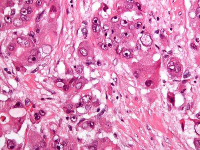 Carcinoma hepatocelular como el utilizado para estudiar el crecimiento tumoral