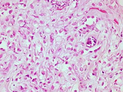 Carcinoma de pecho. Imagen: By Ed Uthman from Houston, TX, USA [CC-BY-2.0 (http://creativecommons.org/licenses/by/2.0)], via Wikimedia Commons