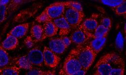 Células procedentes de una biopsia de un paciente con melanoma. En rojo, proteína RAB7 acumulada en los endosomas de las células tumorales. En azúl, núcleos de las células del tumor. Imagen: María Soengas, CNIO