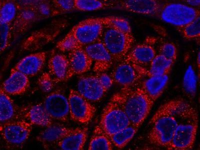 Células procedentes de una biopsia de un paciente con melanoma. En rojo, proteína RAB7 acumulada en los endosomas de las células tumorales. En azúl, núcleos de las células del tumor. Imagen: María Soengas, CNIO