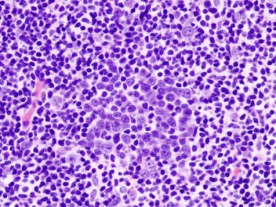 Linfoma  difuso de células B grandes. Imagen: KGH (CC BY-SA 3.0, https://creativecommons.org/licenses/by-sa/3.0/deed.en).
