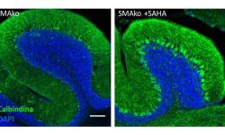 El tratamiento oral con SAHA previene la muerte de las Células de Purkinje en el cerebelo de ratones carentes de esfingomielinasa ácida (SMAko) que son modelo para la enfermedad de Piemann Pick tipo A. La imagen muestra la tinción de las Células de Purkinje con un marcador específico, la calbindina (en verde), junto con la tinción con DAPI de los núcleos (en azul) en secciones de cerebelo de ratones SMAko tratados o no con SAHA por dos meses.
