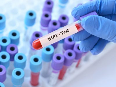 El NIPT es una prueba que analiza el ADN de origen fetal en la sangre materna