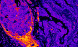 El cáncer de mama (izquierda) presenta niveles nucleares más altos de enzimas productoras de energía que el cáncer de pulmón (derecha). Crédito: Alberto Coll Manzano/Centro de Regulación Genómica