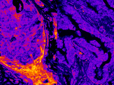El cáncer de mama (izquierda) presenta niveles nucleares más altos de enzimas productoras de energía que el cáncer de pulmón (derecha). Crédito: Alberto Coll Manzano/Centro de Regulación Genómica