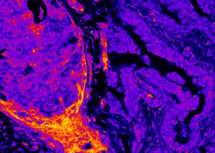 El cáncer de mama (izquierda) presenta niveles nucleares más altos de enzimas productoras de energía que el cáncer de pulmón (derecha). Crédito: Alberto Coll Manzano/Centro de Regulación Genómica