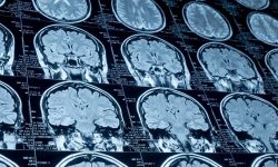 El líquido cefalorraquídeo puede ofrecer información sobre la evolución de tumores cerebrales.