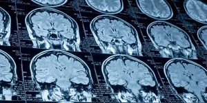 El líquido cefalorraquídeo puede ofrecer información sobre la evolución de tumores cerebrales.