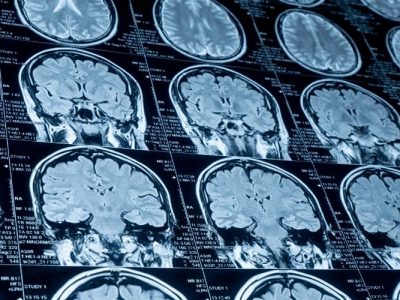 El líquido cefalorraquídeo puede ofrecer información sobre la evolución de tumores cerebrales.