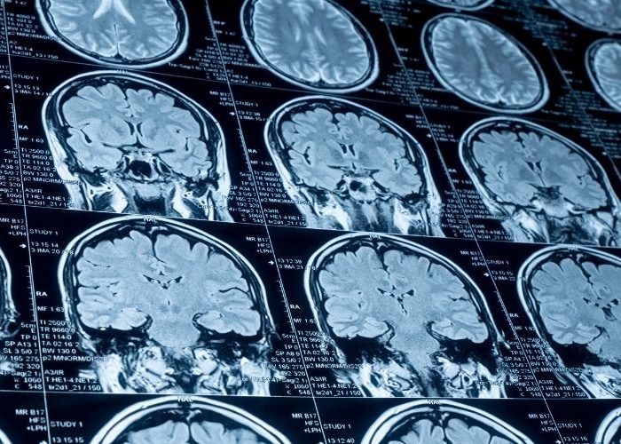 El líquido cefalorraquídeo puede ofrecer información sobre la evolución de tumores cerebrales.