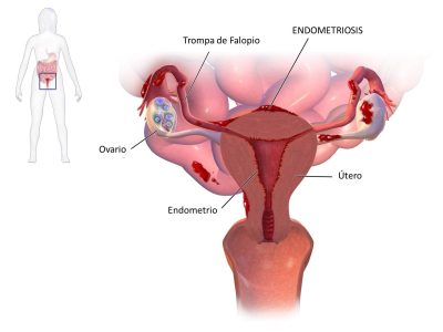 La endometriosis es una condición que se produce cuando las células que recubren el útero crecen en otras regiones del cuerpo. Imagen: Blausen.com staff (2014). "Medical gallery of Blausen Medical 2014". WikiJournal of Medicine 1 (2). DOI:10.15347/wjm/2014.010. ISSN 2002-4436. (Own work) [CC BY 3.0 (http://creativecommons.org/licenses/by/3.0)].