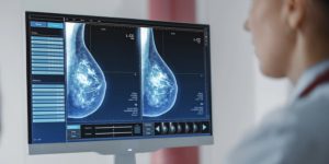 Ensayos prospectivos permitirán comprobar si la cabergolina puede prevenir el cáncer de mama