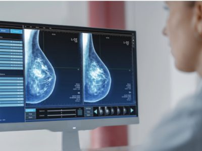 Ensayos prospectivos permitirán comprobar si la cabergolina puede prevenir el cáncer de mama