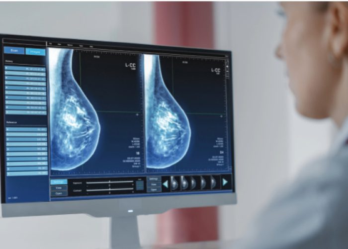 Ensayos prospectivos permitirán comprobar si la cabergolina puede prevenir el cáncer de mama