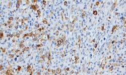 Inmunohistoquímica de MyHC en tumores inducidos con células transfectadas con CAV1. Imagen: Grupo de Investigación de Sarcomas. Laboratorio de Oncología Molecular. Instituto de Investigación Biomédica de Bellvitge (IDIBELL), Barcelona