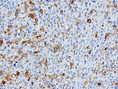 Inmunohistoquímica de MyHC en tumores inducidos con células transfectadas con CAV1. Imagen: Grupo de Investigación de Sarcomas. Laboratorio de Oncología Molecular. Instituto de Investigación Biomédica de Bellvitge (IDIBELL), Barcelona