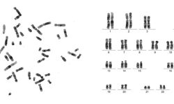 Figura 3. Metafase celular de líquido amniótico, bandeada con la técnica GTG y procesada mediante el software Ikaros, eliminando al ruido de fondo. A la derecha se observa el cariotipo de la misma metafase ordenado según la normativa ISCN , determinado como  cariotipo cromosómicamente masculino sin alteraciones citogenéticas visible a 400 bandas.