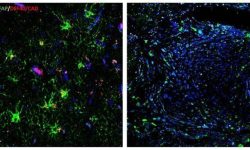 La expresión de la endonucleasa DFF40/CAD en GBM es inferior a la expresión que se observa en tejido sano. En la izquierda se muestra tejido cerebral no tumoral. A la derecha, zona de GBM en el mismo individuo. En azul se muestra el ADN, en verde la proteína glial GFAP y en rojo la endonucleasa DFF40/CAD. Escala 40 micrómetros. Imagen cortesía de María Sánchez-Osuna.