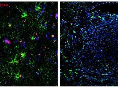 La expresión de la endonucleasa DFF40/CAD en GBM es inferior a la expresión que se observa en tejido sano. En la izquierda se muestra tejido cerebral no tumoral. A la derecha, zona de GBM en el mismo individuo. En azul se muestra el ADN, en verde la proteína glial GFAP y en rojo la endonucleasa DFF40/CAD. Escala 40 micrómetros. Imagen cortesía de María Sánchez-Osuna.