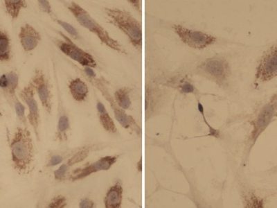 Tinción de colágeno de células con mielofibrosis. Las células no tratadas de la izquierda muestran la presencia de fibrosis, mientras que las células de la derecha, que han recibido tratamiento muestran fibrosis reducida. Imagen: CNIO.
