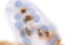 Tumor de próstata deficiente en Pten inducido por transposición en uno de los ratones empleados en este estudio. Mediante análisis de inmunohistoquímica se observa cómo Pten (teñido de marrón) está presente en el epitelio normal y se pierde en el tumor.