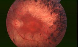 Fondo de ojo de un paciente con retinosis pigmentaria. Imagen: http://dx.doi.org/10.1186/1750-1172-1-40